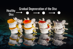 What Is Degenerative Disc Disease?