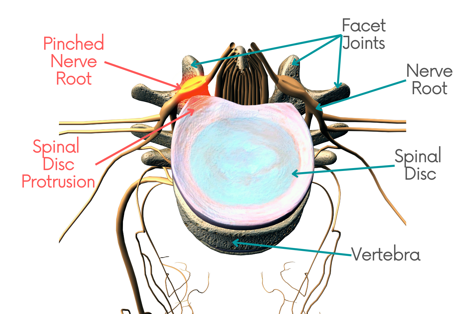 Herniated Disc L5 S1 Nerve Root Compression