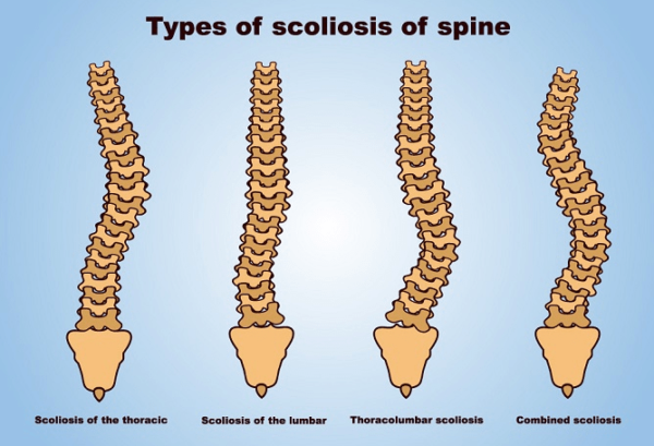 Scoliosis Conditions