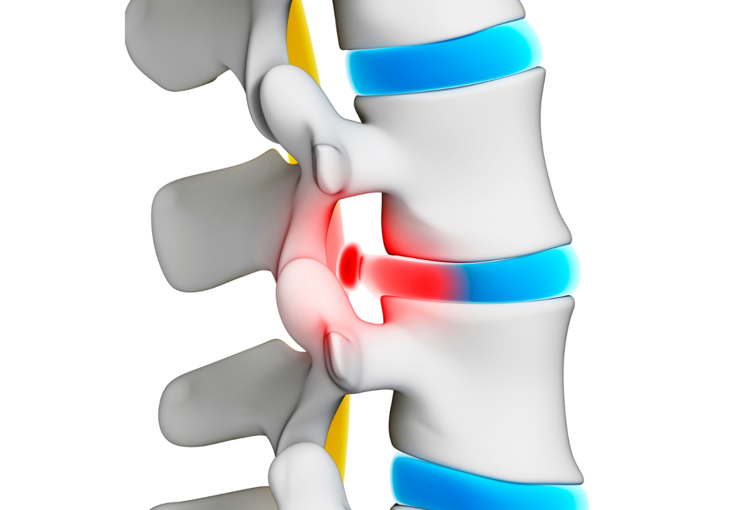 prevention of slipped disc Archives Spinal Backrack