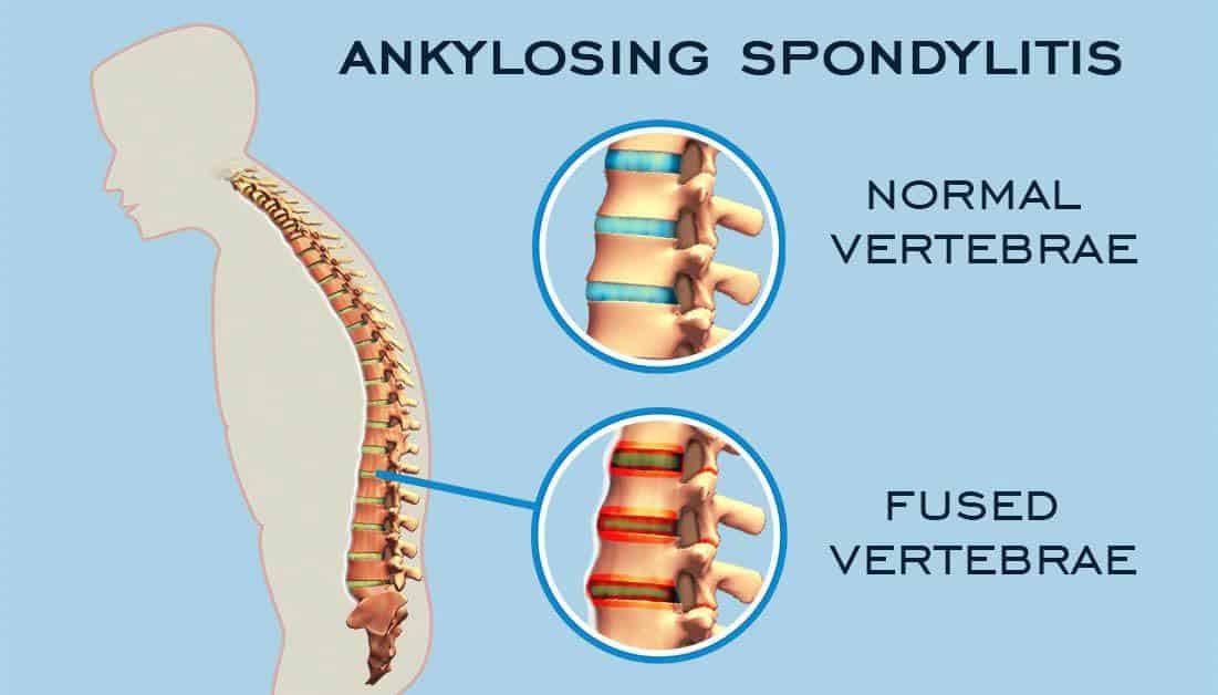 Ankylosing Spondylitis Treatment Modalities Spinal Backrack