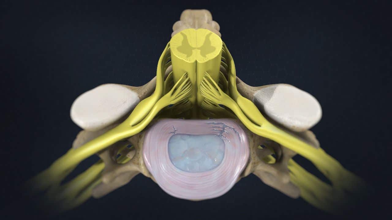 Annular Tearing How Does It Happen? What Are Treatment Options