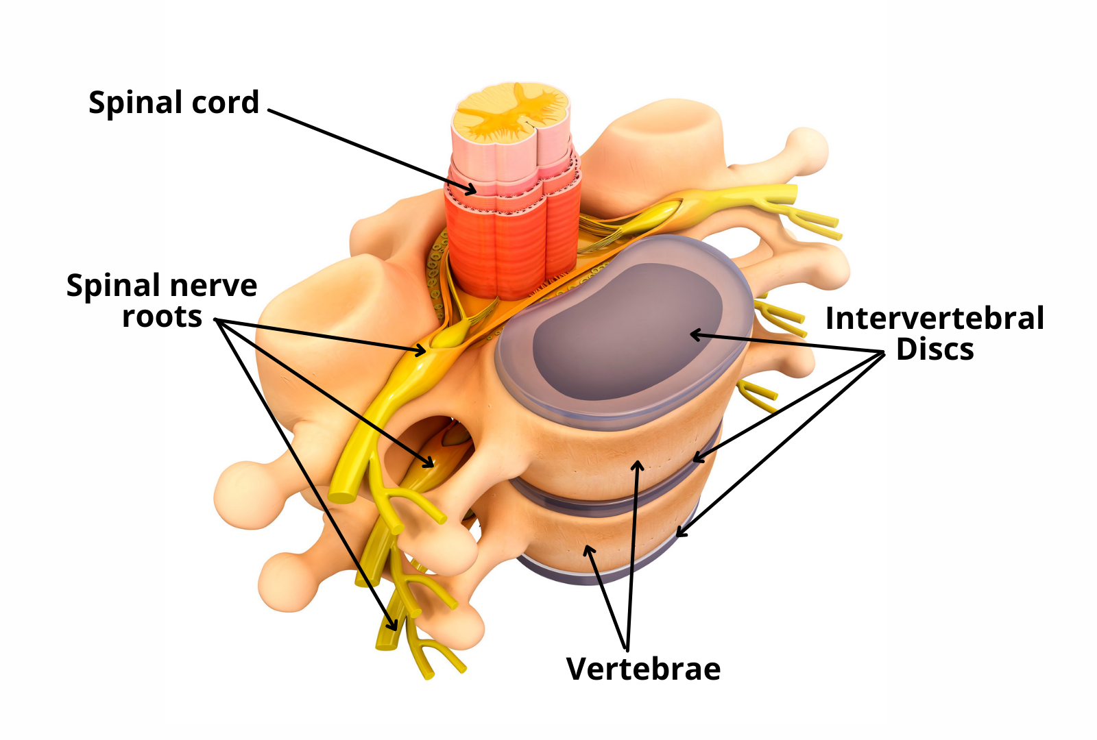 Compressed nerve roots