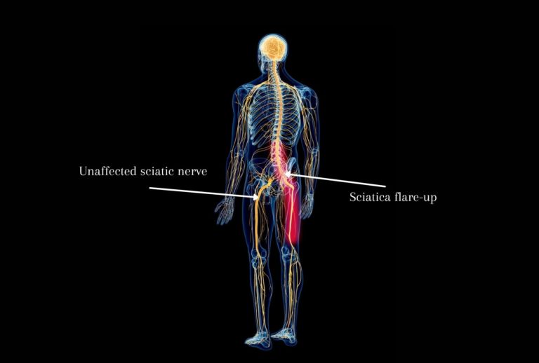 Is Walking Good for Sciatica? And if not, What Can Help Instead?