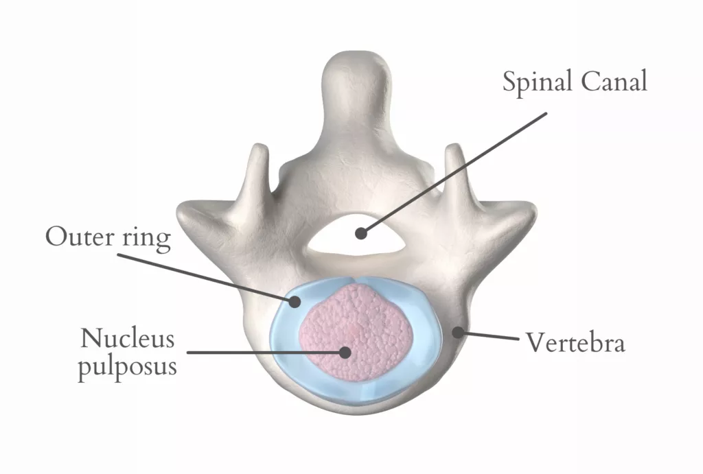 Intervertebral Disc Prolapse Nhs