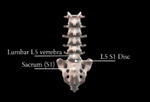 L5-S1 disc pain