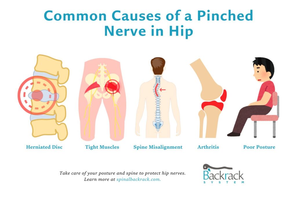 common causes of pinched nerve in hip - Spinal Backrack