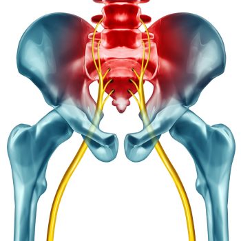 Sciatica-Pain